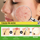 Kit Skincare Anti Oleosidade e Acne Salicílico + Sérum Secativo Dermachem